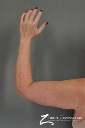 Arm Lift: Patient 1 - After Image 2