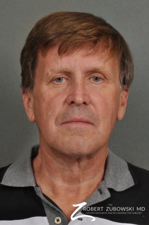Neck Lift: Patient 3 - After Image 1