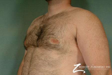 Gynecomastia: Patient 7 - After Image 2