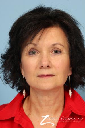 Blepharoplasty: Patient 25 - After Image 1