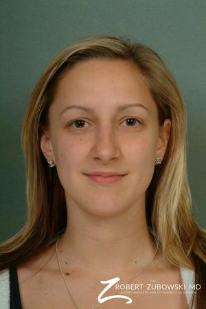 Rhinoplasty: Patient 11 - After Image 1