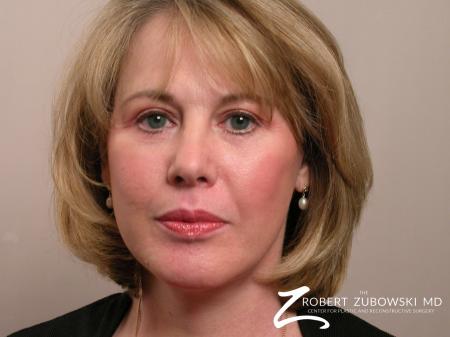 Facelift: Patient 1 - After Image 1