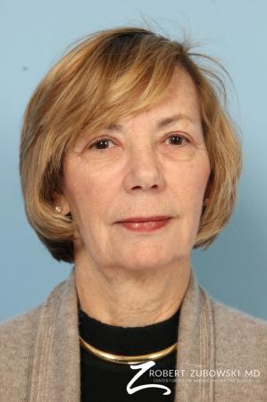 Blepharoplasty: Patient 32 - After Image 1