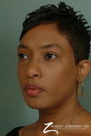 Blepharoplasty: Patient 3 - After Image 2