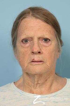 Blepharoplasty: Patient 38 - Before Image 1
