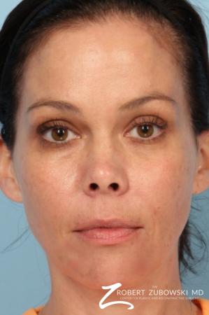 Fillers: Patient 2 - After Image 1