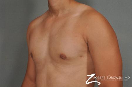 Gynecomastia: Patient 3 - After Image 2