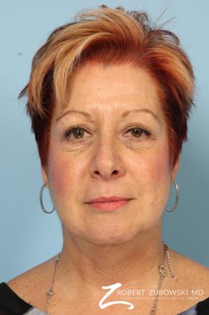 Blepharoplasty: Patient 13 - Before Image 1