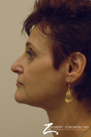 Facelift: Patient 9 - Before and After Image 2