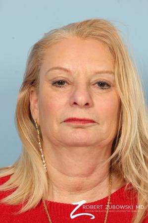 Blepharoplasty: Patient 17 - After Image 1