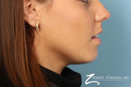 Permanent Lip Enhancement: Patient 2 - Before and After Image 2