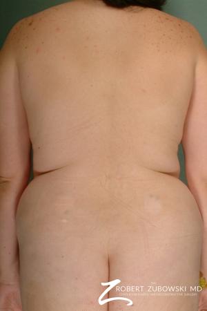 Liposuction: Patient 25 - Before Image 1
