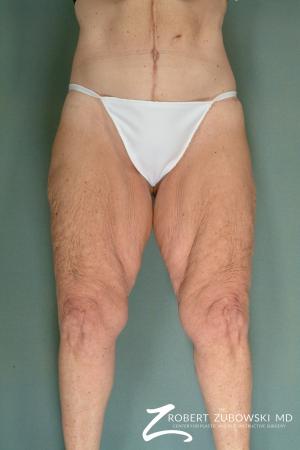 Thigh Lift: Patient 1 - Before Image 1