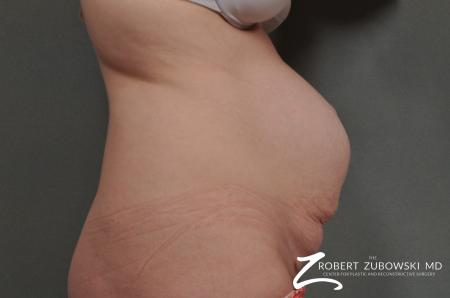 Tummy Tuck: Patient 4 - Before and After Image 2