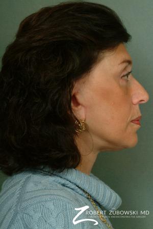 Brow Lift: Patient 6 - After Image 2