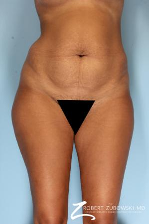 Liposuction: Patient 49 - Before Image 1