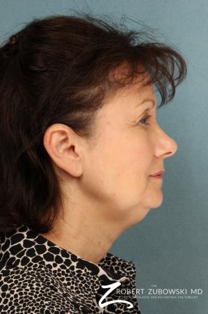 Facelift: Patient 22 - Before and After Image 2