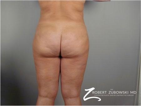 Liposuction: Patient 41 - After Image 3