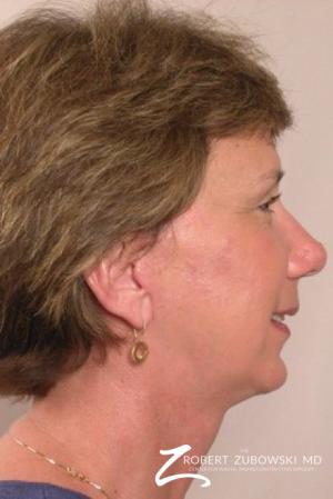 Facelift: Patient 8 - After Image 2