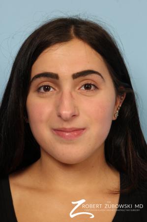 Rhinoplasty: Patient 24 - Before Image 1