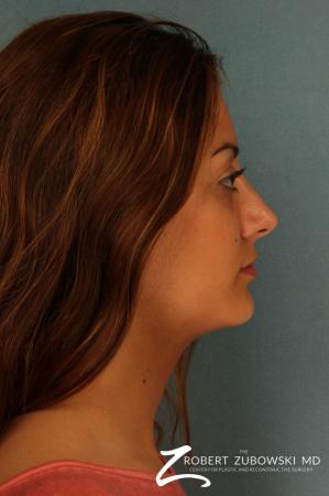 Rhinoplasty: Patient 16 - After Image 2