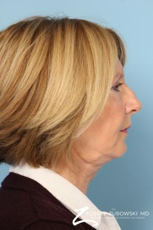 Facelift: Patient 20 - Before and After Image 2