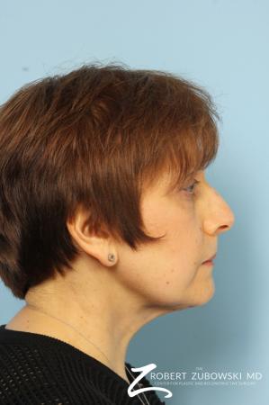 Blepharoplasty: Patient 14 - After Image 2