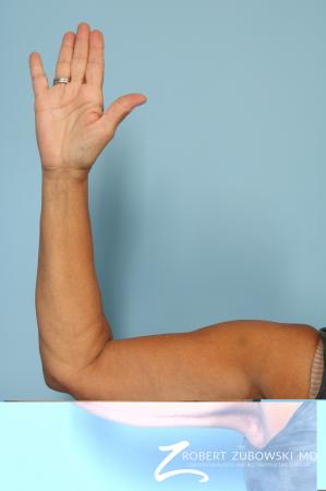 Arm Lift: Patient 5 - After Image 2