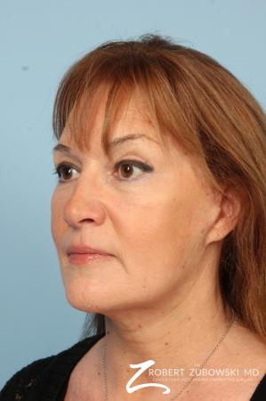 Chemical Peel: Patient 1 - After Image 2