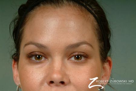 Latisse: Patient 2 - After Image 2