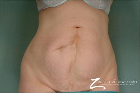 Tummy Tuck: Patient 22 - Before Image 1