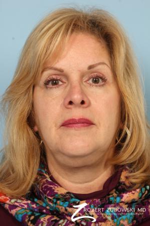 Blepharoplasty: Patient 34 - Before and After Image 2