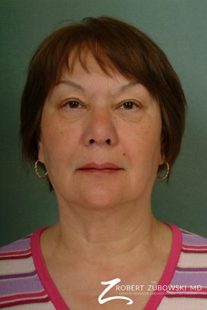 Blepharoplasty: Patient 23 - After Image 1