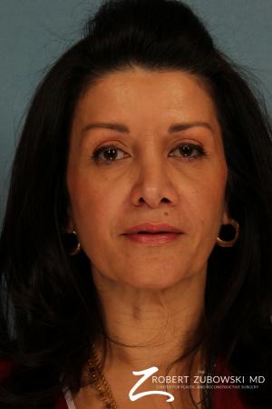 Brow Lift: Patient 5 - After Image 1