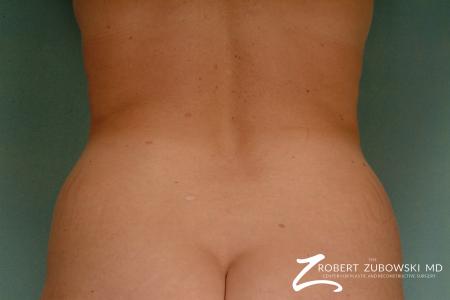 Liposuction: Patient 34 - Before Image 1