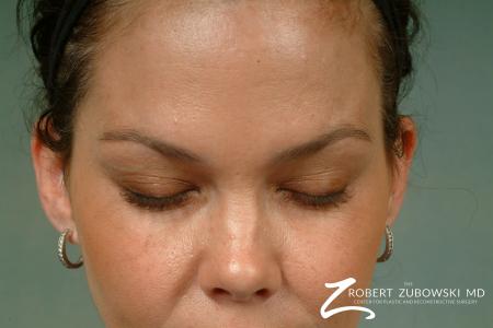 Latisse: Patient 2 - After Image 1