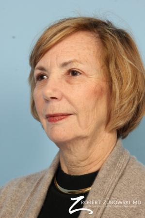 Blepharoplasty: Patient 32 - After Image 2