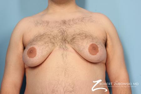 Gynecomastia: Patient 6 - Before Image 1