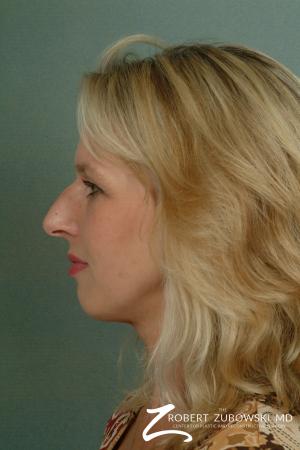 Rhinoplasty: Patient 10 - Before Image 2