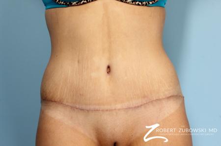 Tummy Tuck: Patient 17 - After Image 1