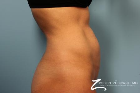 Tummy Tuck: Patient 14 - Before and After Image 2