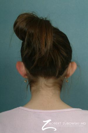 Otoplasty: Patient 6 - Before and After Image 2