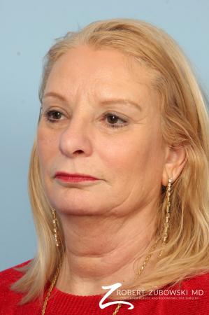 Blepharoplasty: Patient 17 - After Image 2