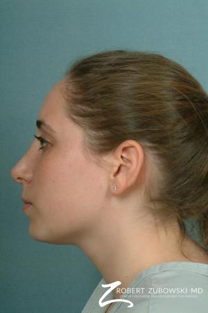 Rhinoplasty: Patient 7 - After Image 2