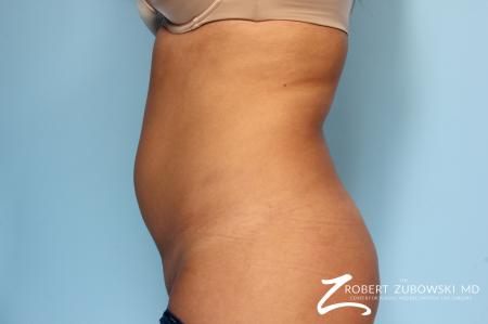Liposuction: Patient 12 - Before Image 1
