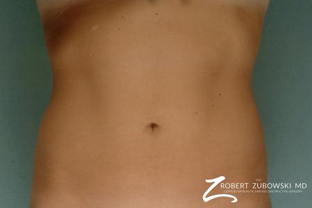 Liposuction: Patient 26 - After Image 1