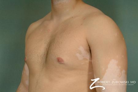 Gynecomastia: Patient 5 - After Image 2
