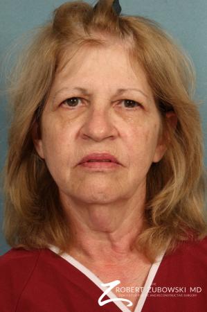 Facelift: Patient 23 - Before Image 1