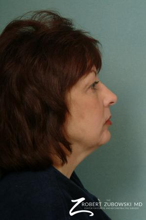 Laser: Patient 1 - Before Image 1