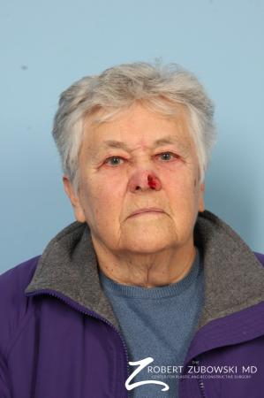Mohs Closure: Patient 3 - Before Image 1